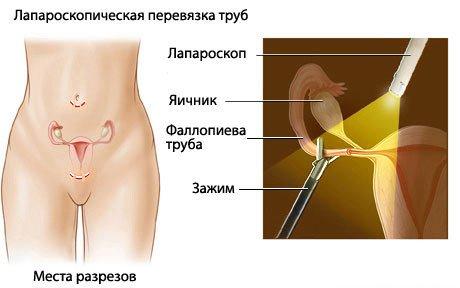 лапароскопическая перевязка труб