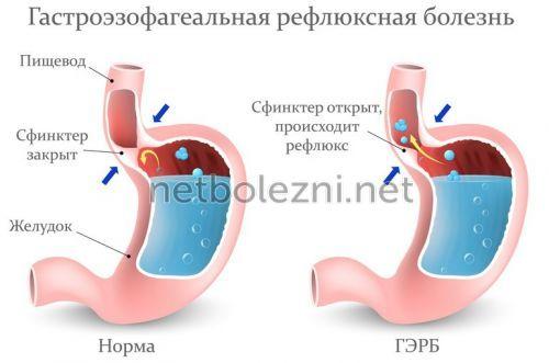 1497603855_process-reflyuksa-ezofagit.jpg