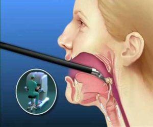 26_05_2017-mouth_cancer-300x249.jpg