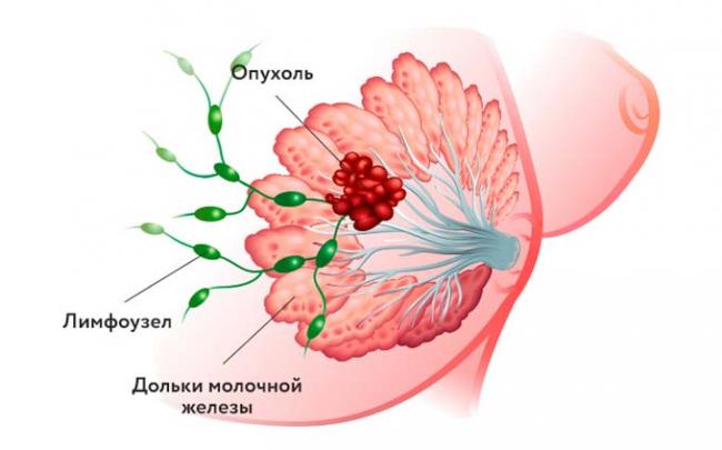 опухоль в груди