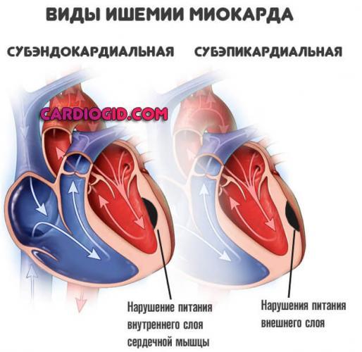 vidy-ishemii-miokarda.jpg