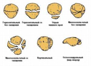 Vidy-perelomov-kolennoj-chashechki-300x216.jpg