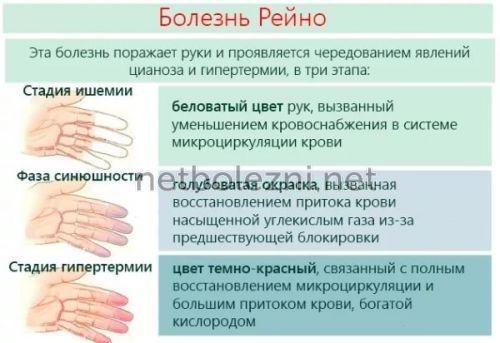 1497740203_bolezn-reyno.jpg