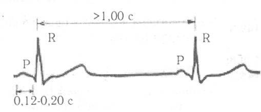 bradikardiya_sinusovaj_ekg.jpg