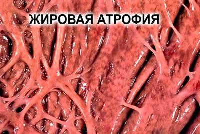 atrofiya-levogo-zheludochka-serdca-chem-opasna-simptomy-kak-lechit_2.jpg