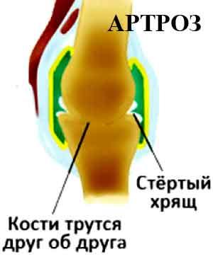 боль-при-артрозе.jpg