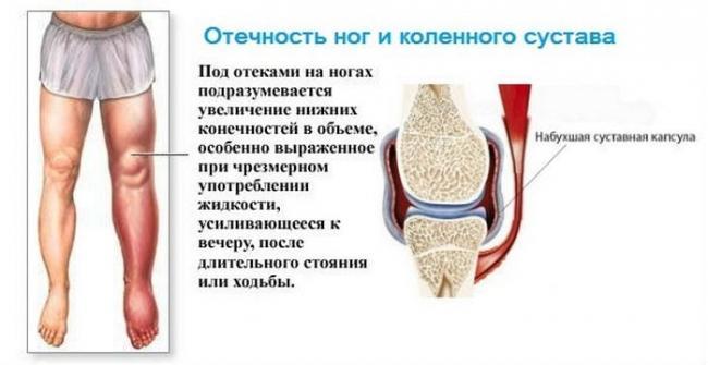 Deformiruyushhij-artroz-kolennogo-sustava-1-stepeni.jpg