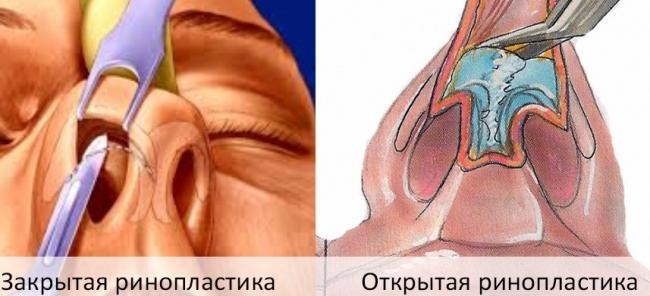 Otkrytaya-i-zakrytaya-rinoplastika.jpg