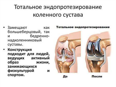 Foto-6.-E`ndoprotezirovanie-450x337.jpg 