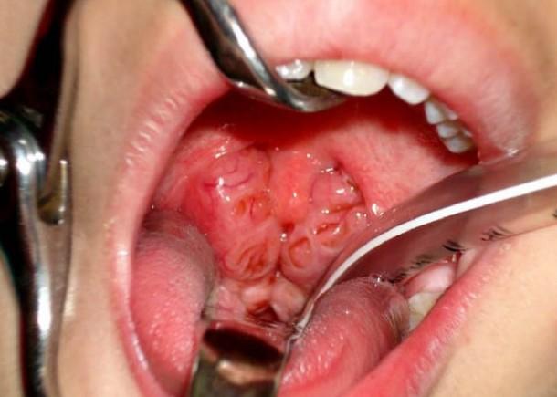 adenoidy-3-stepeni.jpg