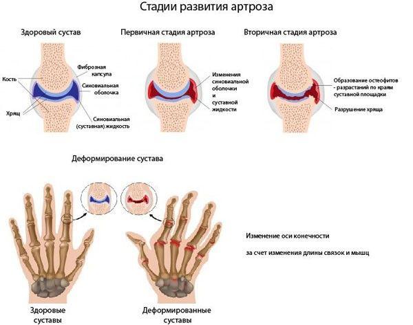 osteoartroz-kstrklc-3-600x473.jpg