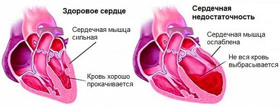 serdechnaya-nedostatochnost.jpg