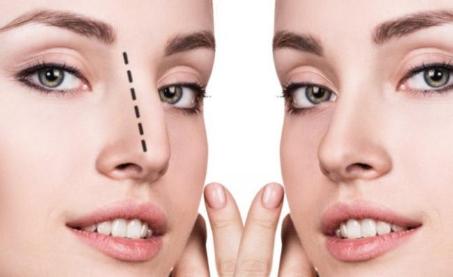 Operaciya-rinoplastika-nosa1.jpg