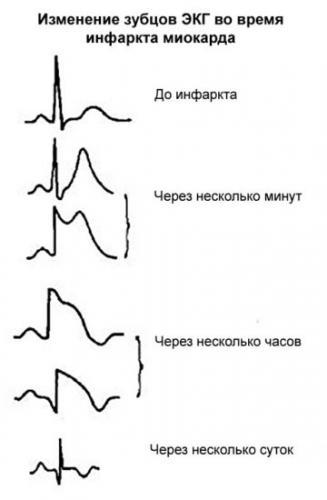 экг-при-инфаркте.jpg