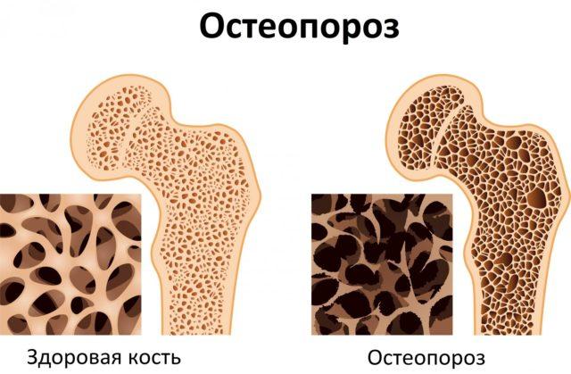 test-na-prochnost-kostey-metod-densitometrii-640x419.jpg