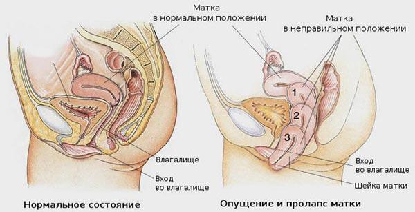 пролапс матки