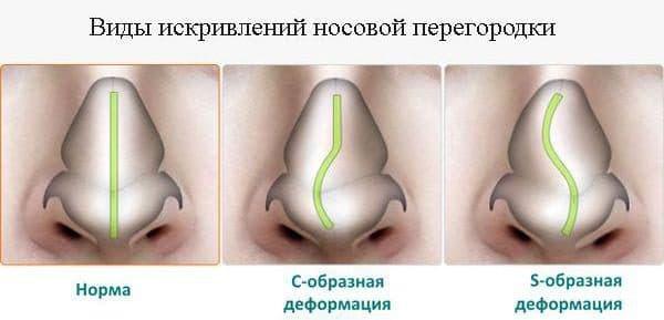 %D0%98%D1%81%D0%BA%D1%80%D0%B8%D0%B2%D0%BB%D0%B5%D0%BD%D0%B8%D0%B5-%D0%BD%D0%BE%D1%81%D0%BE%D0%B2%D0%BE%D0%B9-%D0%BF%D0%B5%D1%80%D0%B5%D0%B3%D0%BE%D1%80%D0%BE%D0%B4%D0%BA%D0%B8-600x289.jpg