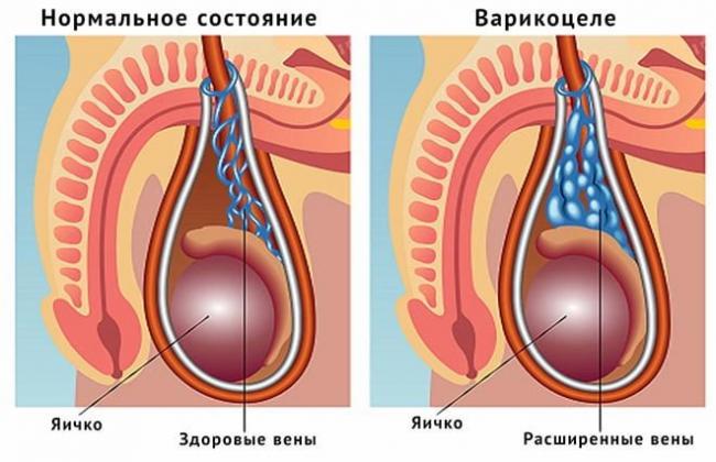 нормальное состояние и варикоцеле