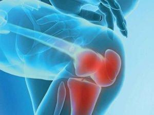 artroz-kolennogo-sustava-300x225.jpg