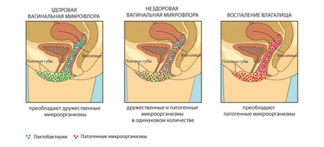 вагинальная микрофлора