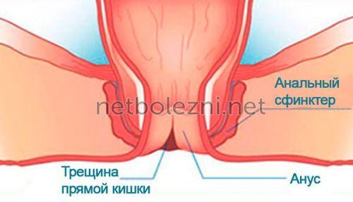1516646690_analnaya-treschina.jpg