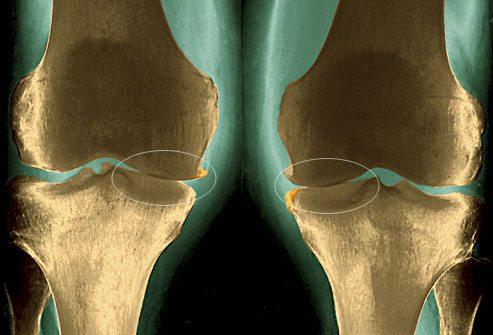 phototake_rm_photo_of_xray_of_knees_with_osteoarthritis.jpg
