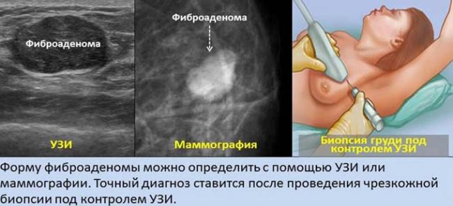 диагностика фиброаденомы