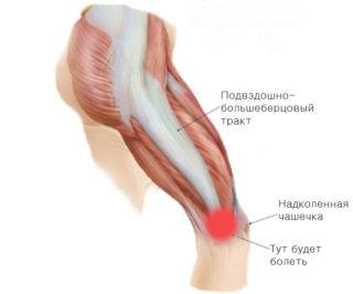 Iliotibial-Band-Syndrome1-320x266.jpg