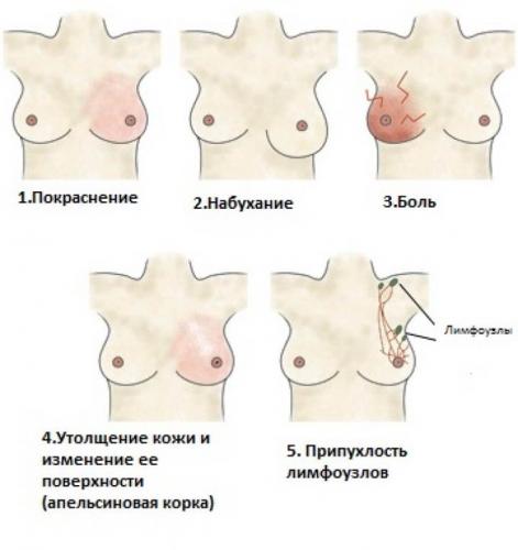 симптомы мастита