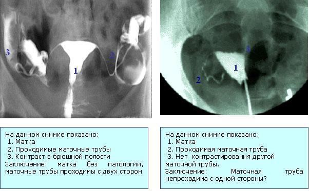 снимок проходимости маточных труб