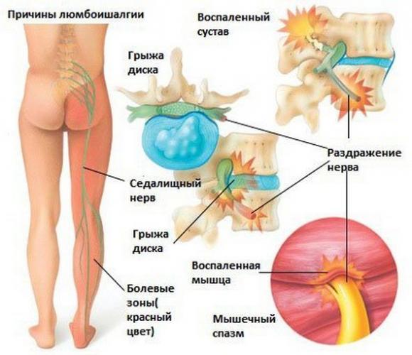 bol-v-pojasnice-sleva-otdaet-v-nogu.jpg