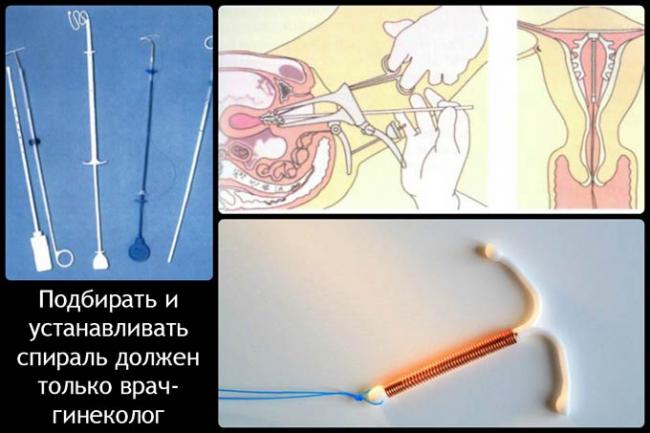 подбор внутриматочной спирали