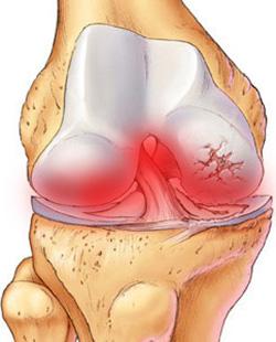 simptomyilechenievirusnogoartrita5.jpg