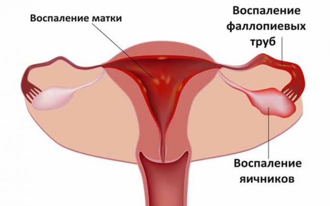 воспаление матки