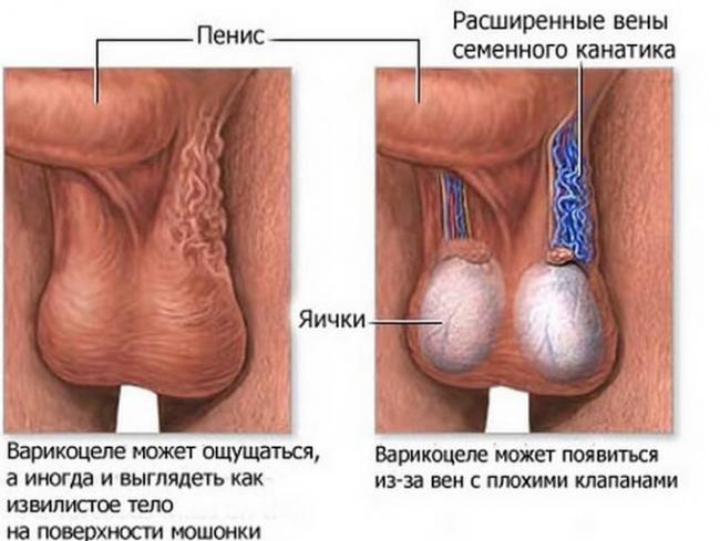 расширенные вены семенного канатика