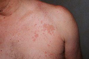 churg-strauss-syndrome-skin-rash-300x200.jpg