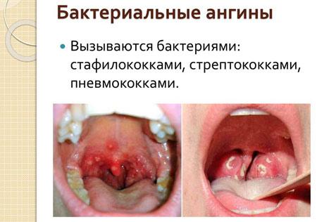 Прыщи в горле как симптомы заболеваний: причины, диагностика, способы лечения