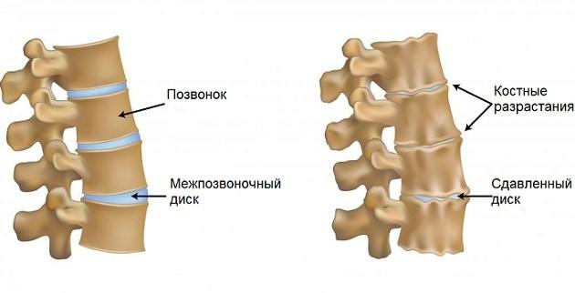ris6-unkovertebralniy-artroz.jpg