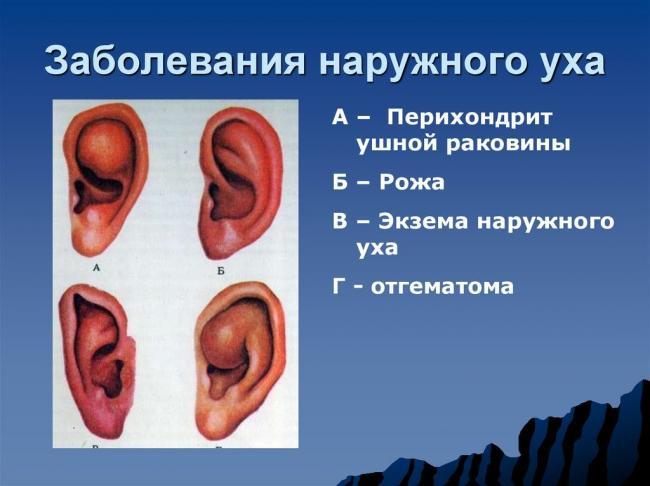 zabolevanie-naruzhnogo-uha-1024x767.jpg