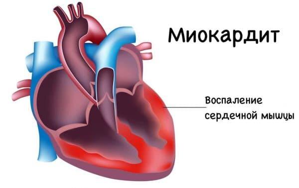 miokardit-600x378.jpg
