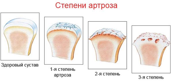 invalidnost-pri-artroze-2.jpg