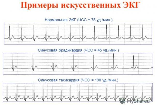 Tahikardiya-i-bradikardiya-na-kardiogramme-vyglyadyat-tak.jpg