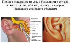 gnoinye-vydeleniya-iz-uha.jpg