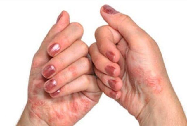 Dieta-pri-psoriaticheskom-artrite-2-e1528733125307.jpg