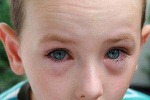 VisionFirst_bigstock-Boy-with-allergy-conjunctivit-18983612-1024x683-300x200.jpg