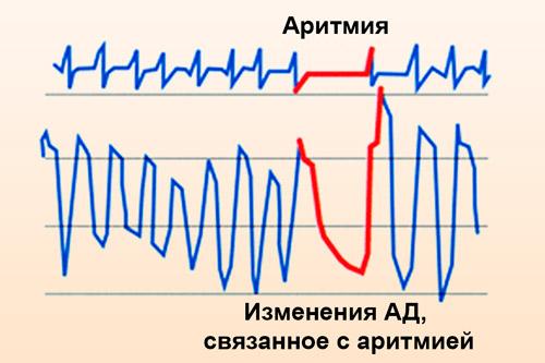 aritmiya-serdca-lechenie-tabletki_1.jpg