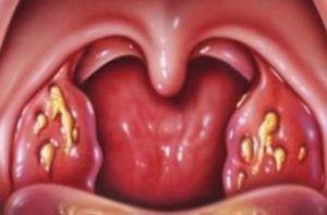gribok_gorla-300x198.jpg