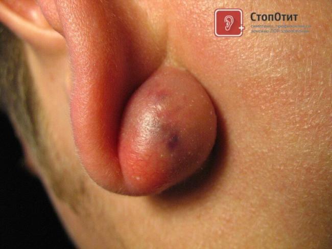 ateroma-1.jpg