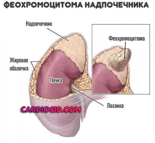 opuhol-nadpochechnika.jpg