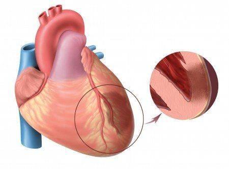 obshirnyj-infarkt-miokarda.jpg